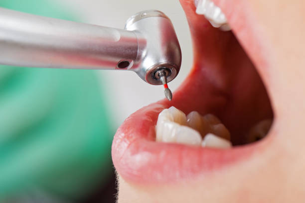Best Emergency Wisdom Tooth Extraction in Greenfield, IN